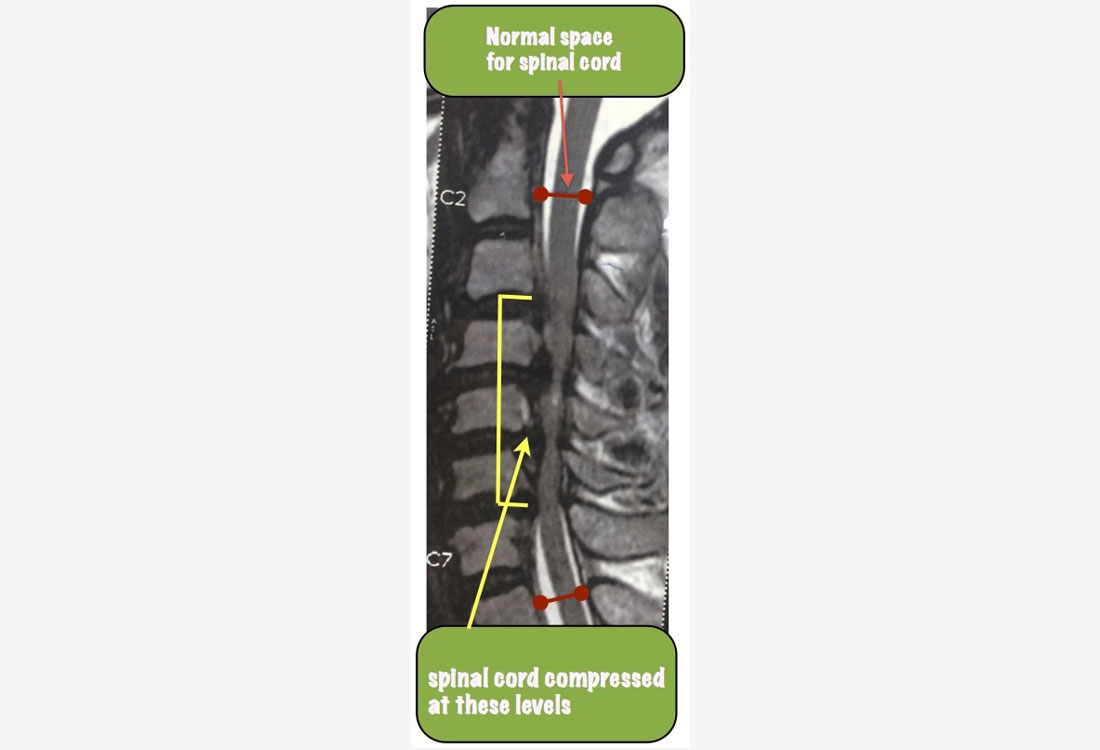 cervical spinal cord stenosis 1