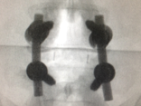 one level pedicle screw fixation lumbar spine