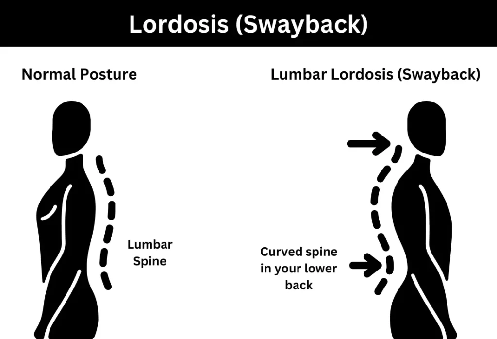 Normal posture vs lumbar lordosis (swayback)
