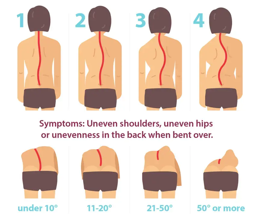 Scoliosis severity stages with curved spine