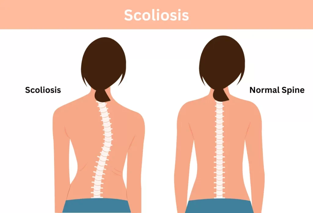 Scoliosis vs normal spine back view illustration